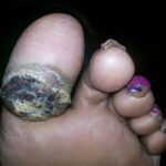 Callosity-2-Before-scraping1 Before Treatment