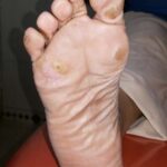 Corn-Patient-2-1 Before Treatment