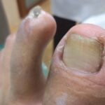 In-growing-Toe-Nail-1-1