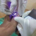 Ingrowing-Toe-nail-4