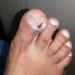 Ingrowing-toe-nail-with-infection